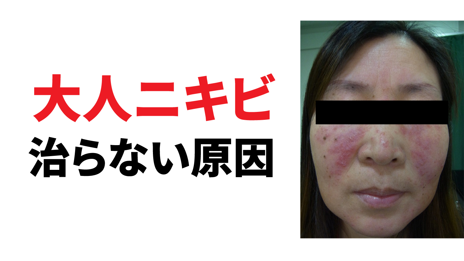 大人ニキビが治らない原因。実は酒さという病気かも知れません