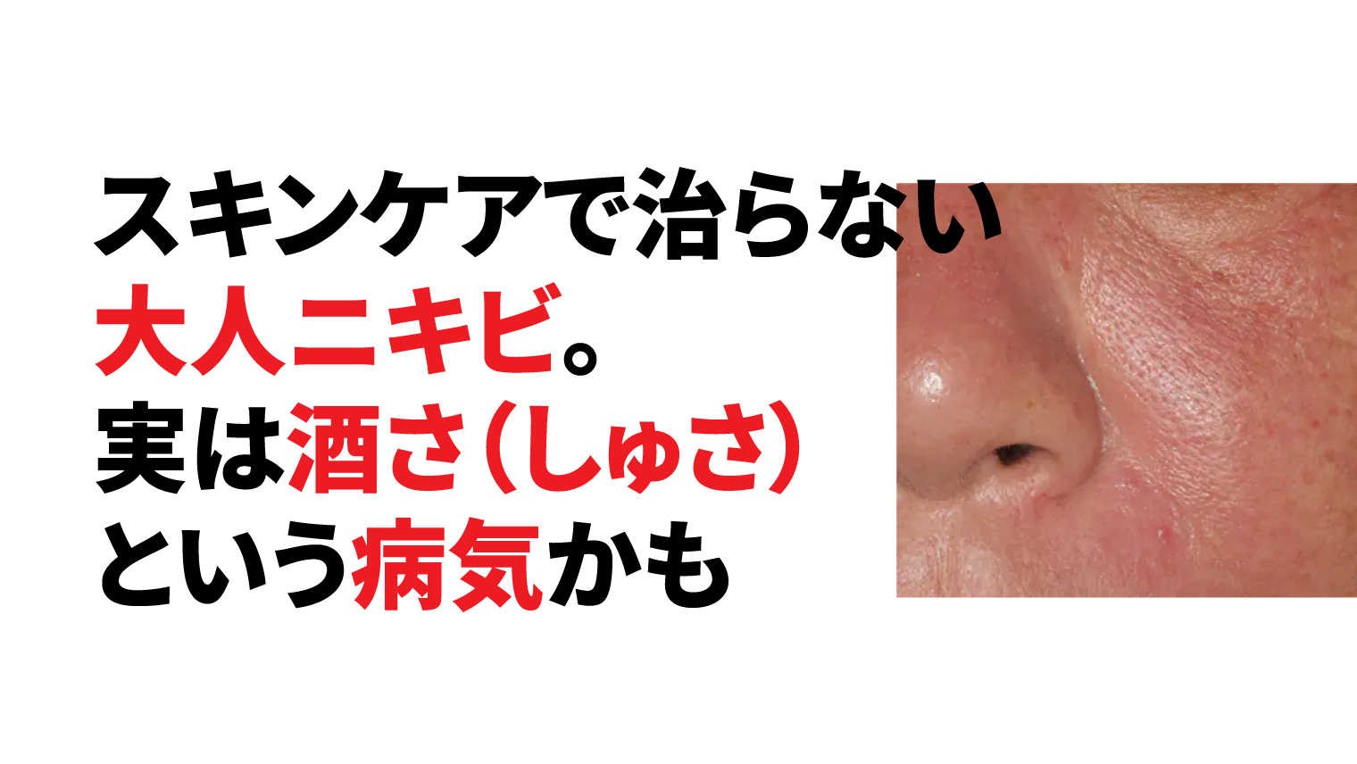 スキンケアで治らない大人ニキビ。実は酒さ(しゅさ)という病気かも