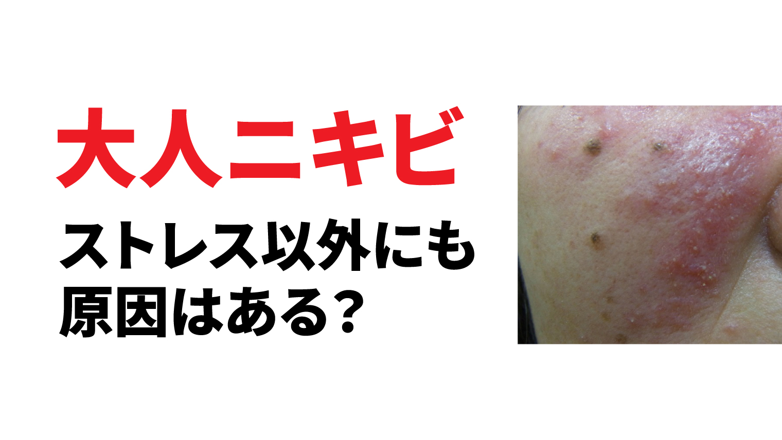 大人ニキビとストレスの関係