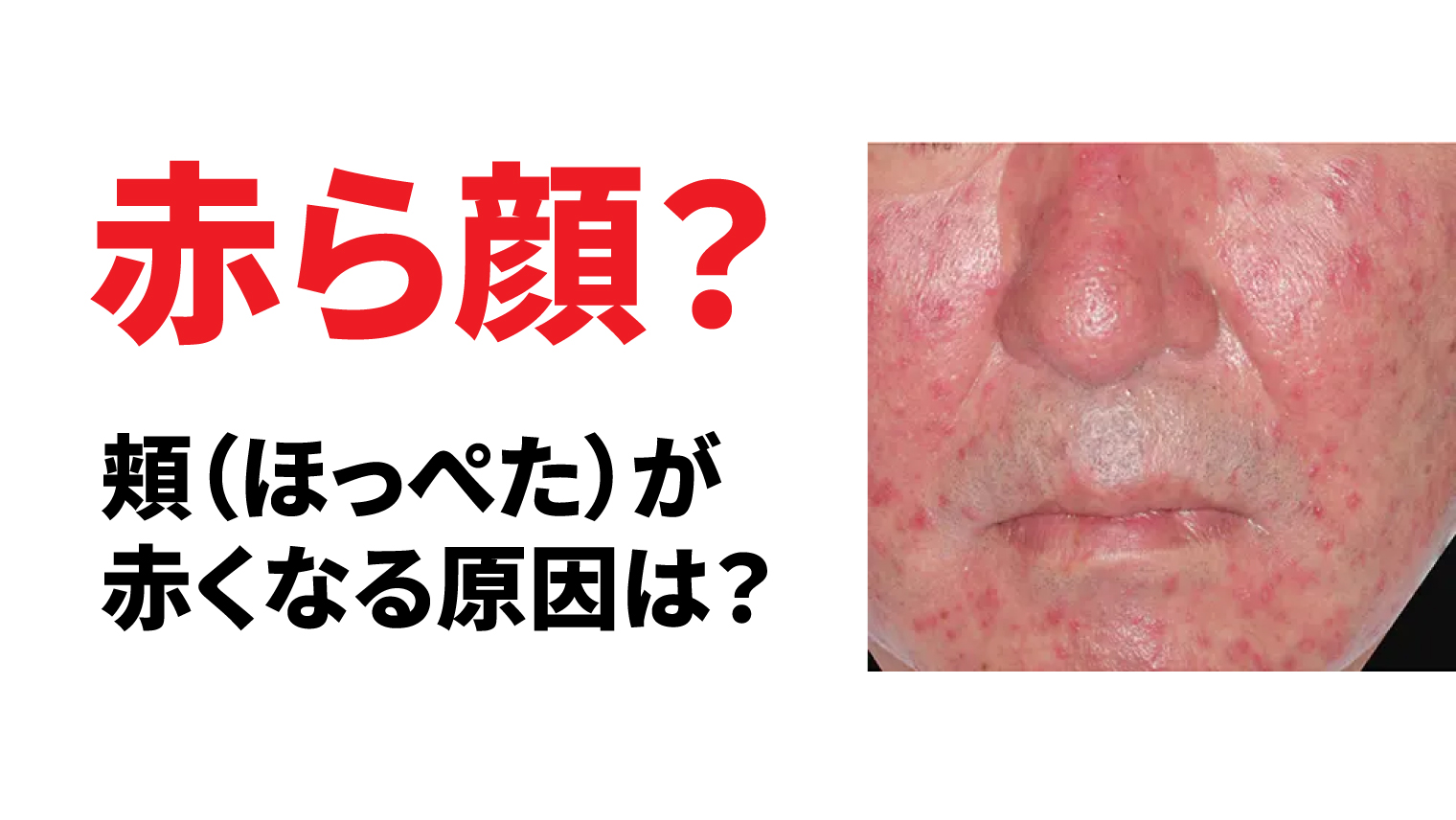 赤ら顔?頬(ほっぺた)が赤くなる原因は?