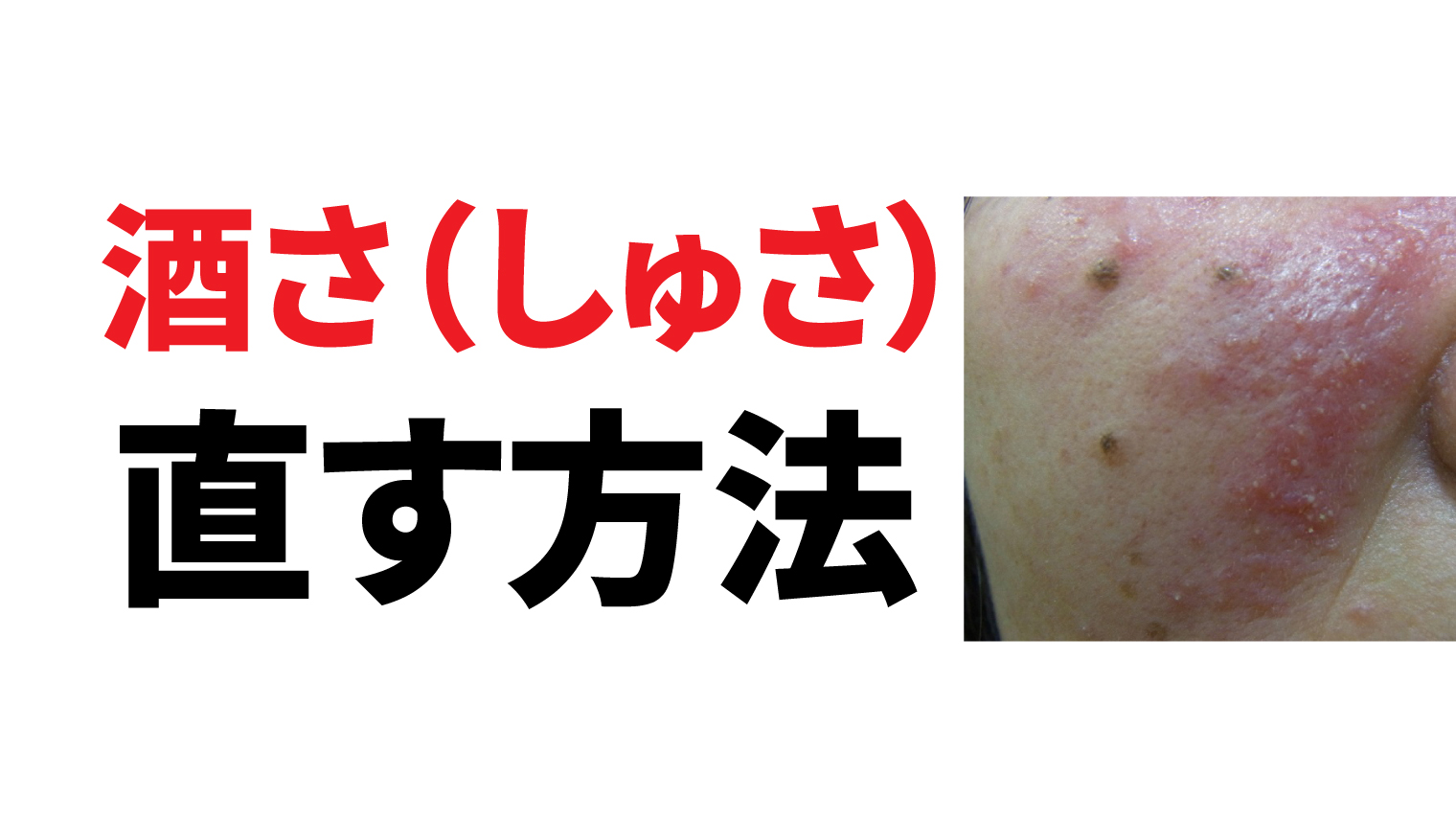 酒さを直す方法