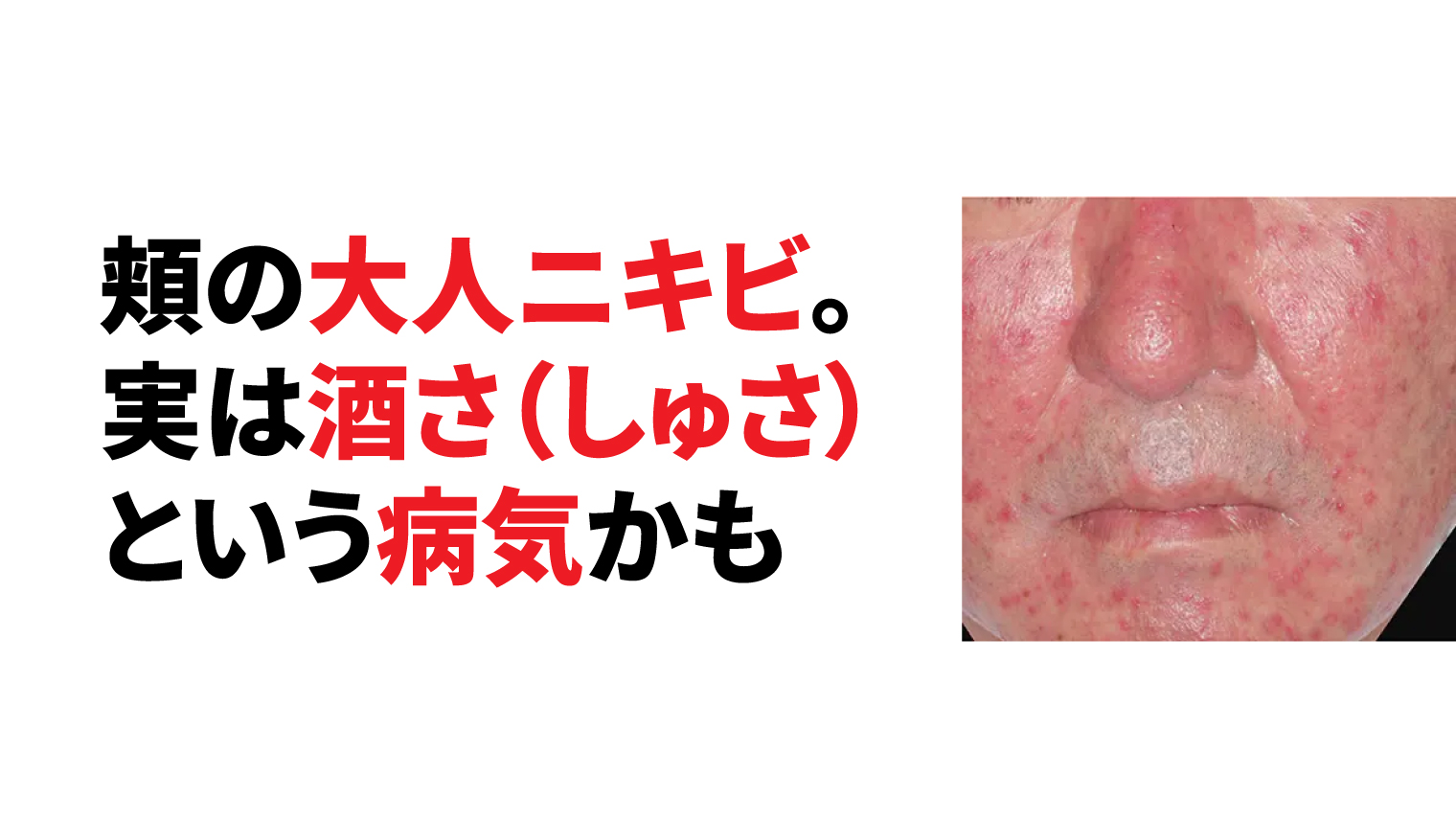 頬(ほっぺた)の大人ニキビの原因。実は酒さという病気かも知れません